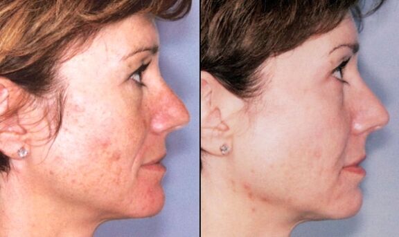 Rejuvenecer